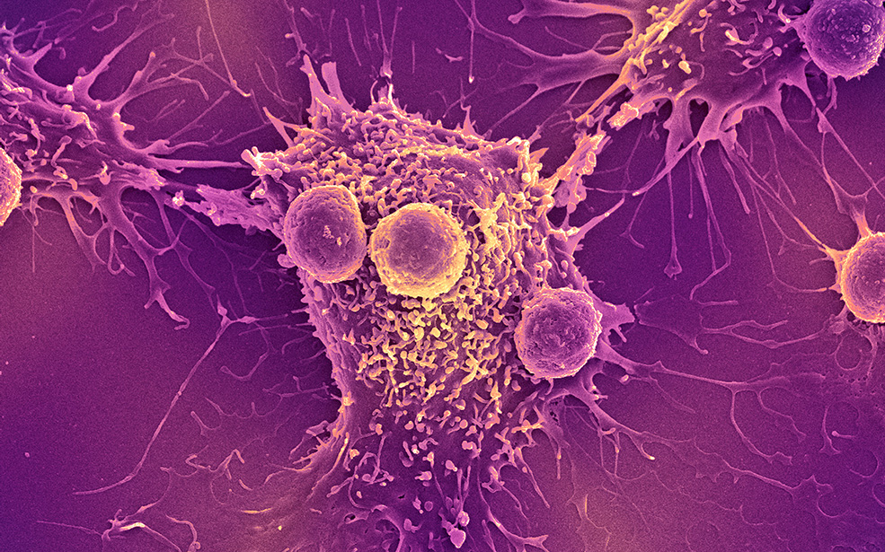 Cancer cell and T lymphocytes, SEM