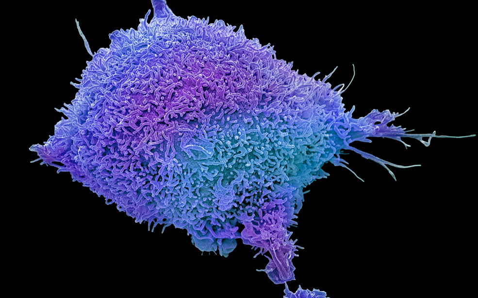 Cervical cancer cell, SEM