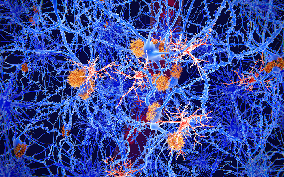 Amyloid and microglia cells in Alzheimer's, illustration